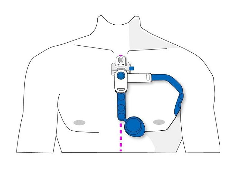 appareil Sensinel d’ADI pour la mesure et la collecte à distance d’indicateurs cardiopulmonaires (installé sur la poitrine d'un homme)